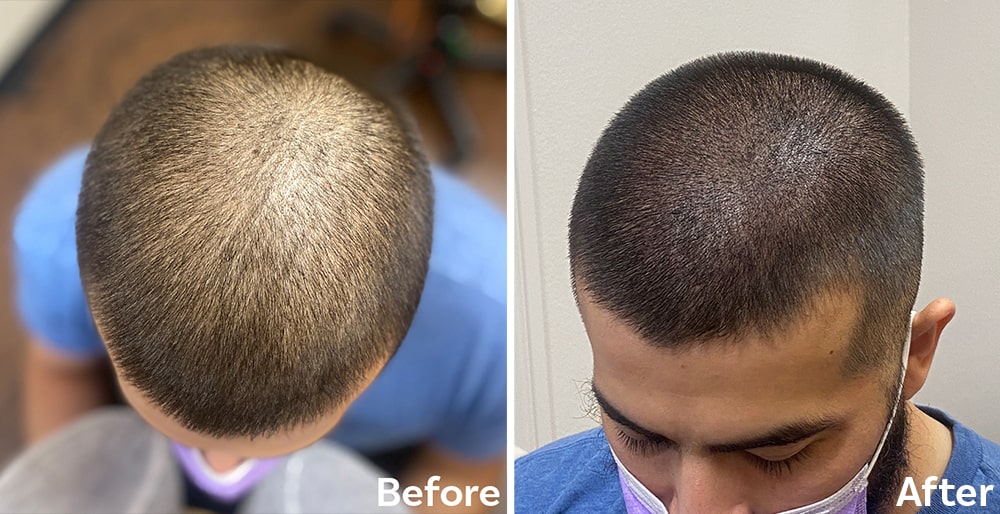 Scalp-Micropigmentation-Density-treatment