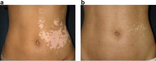 Treatment-of-segmental-vitiligo-in-case-18-a-Before-surgery-b-Two-years-and-9months