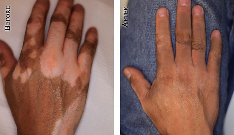 Vitiligo-1-hands-1200x819-1