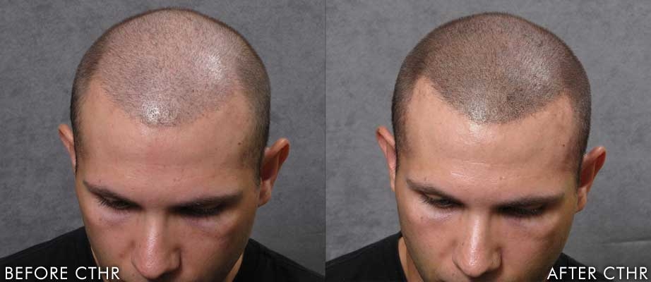scalp-micro-pigmentation